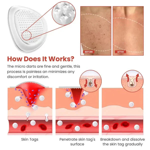 DermaSmooth Skin Tag Remover